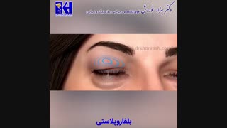 انیمیشن بلفاروپلاستی