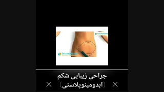 جراحی زیبایی شکم یا ابدومینوپلاستی