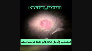 چگونگی ایجاد زخم معده در بدن انسان
