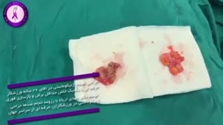 جراحی اصلاح ژنیکوماستی در اقای ۲۶ ساله ورزشکار حرفه ای