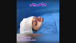 بلافاصله پس از اتمام جراحی بینی | دکتر رفیع