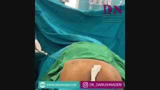 تزریق چربی به باسن لیزر فرکشنال