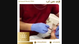 تزریق ژل لب