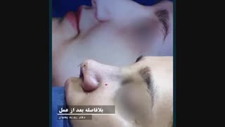 رینوپلاستی در تهران