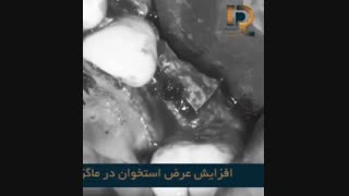 تکنیک ریج اسپلیت و قراردهی همزمان ایمپلنت