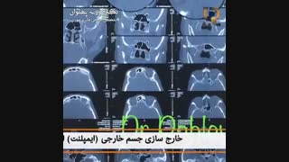 خارج سازی جسم خارجی