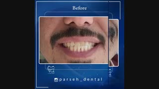 ونیر کامپوزیت