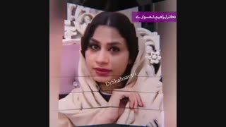 نمونه جراحی بینی دکتر شهسواری جراحی پف زیر چشم