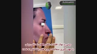 جراحی بینی اولیه با نوک افتاده | دکتر باستانی نژاد | جراح بینی