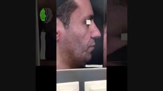 جراحی زیبایی بینی همزمان با آندوسکوپی سینوس | دکتر باستانی نژاد