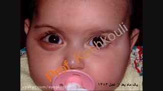 فیلم جراحی حدقه در یک کودک | پروفسور کشکولی