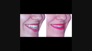 ارتودنسی بدون جراحی فک | دکتر داودیان