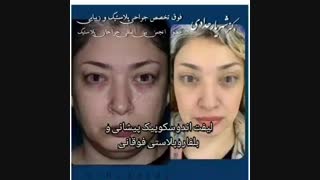 لیفت اندوسکوپی پیشانی و بلفاروپلاستی فوقانی