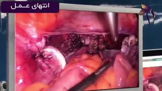 درآوردن رحم در خانم ۴۸ ساله با حفظ تخمدان ها