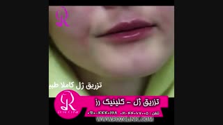 فیلم تزریق ژل | کلینیک رز | 09104440228 | شماره 176