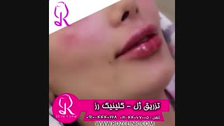 فیلم تزریق ژل | کلینیک رز | 09104440228 | شماره 177