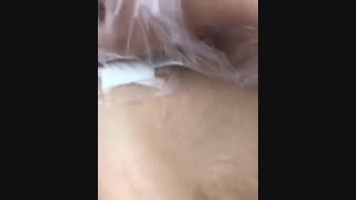 برداشتن پانسمان و بخیه های چسبی لاپاروسکوپی بعد از عمل