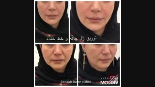فیلم نحوه تزریق ژل خط خنده و چانه جراحی گوش