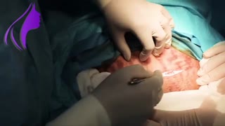 فیلم زایمان سزارین دکتر شهنار پوربرفه ای