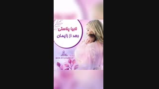 لابیاپلاستى بعد از زایمان