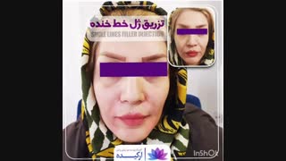 تزریق ژل خط خنده در کلینیک ارکیده