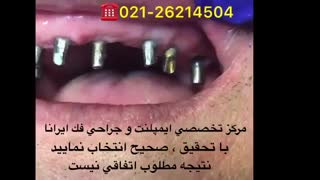 بهترین مرکز ایمپلمنت دندان در تهران