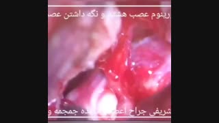فیلم جراحی عصب هشتم و درمان اختلال شنوایی در خانم جوان پرستار