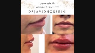 تزریق فیلر لب