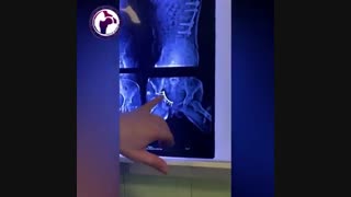 تعویض مفصل در شکستگی استابولوم