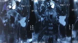 جراحی تومور گردن و اتصال به عمق پاروتید