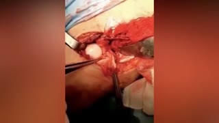 دررفتگی مادرزادی لگن در خواهران دوقلو