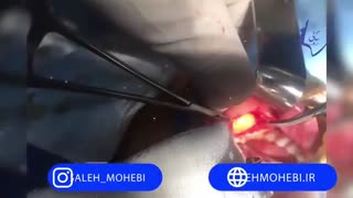 جراحی توده بوکال از طریق دهان