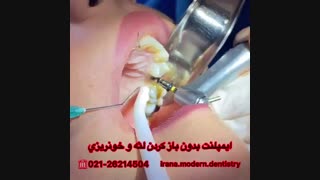 ایمپلنت دندان بدون باز کردن لثه