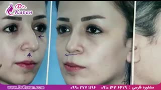 عمل بینی توسط دکتر کاوان