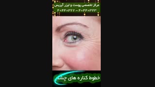 جوانسازی صورت با بوتاکس مزوتراپی