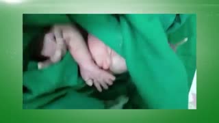 فیلم زایمان سزارین دوقلویی دکتر الهام قلی پور در ساری لیپوماتیک