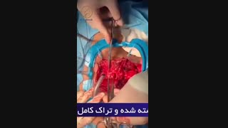 بازسازی راه هوایی و رزکسیون تنگی تراشه بدنبال