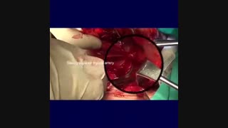 عود پری استوما