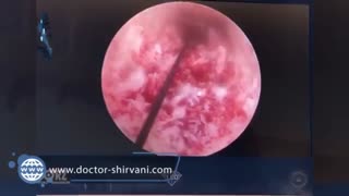 فیلم واقعی جراحی رباط صلیبی زانو