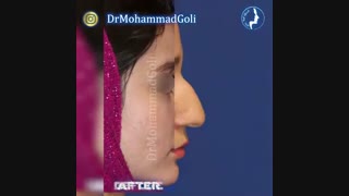 یکسال و نیم بعد از جراحی بینی نیمه فانتزی | دکتر گلی