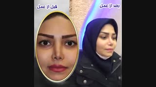 جراحی بینی ترمیمی توسط بهترین جراح بینی تهران دکتر گلی