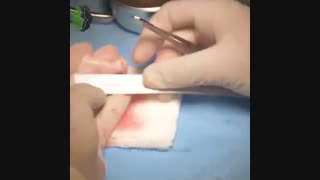 جراحی بینی ترمیمی با سابقه دو بار جراحی بینی | دکتر باستانی نژاد