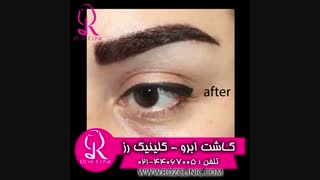 فیلم کاشت ابرو | کلینیک رز | 09104440228 | شماره 208