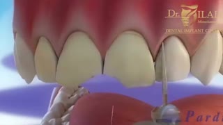 میزان تراش دندان ها در لمینت دندان