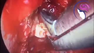 گرفتگی بینی دو طرفه