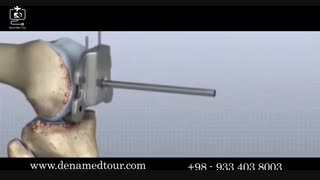 جراحة استبدال مفصل الرکبة