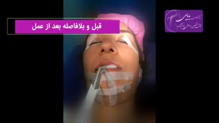 نمونه کار جراحی زیبایی بینی گوشتی