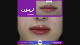 تزریق ژل لب در کلینیک ارکیده