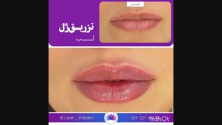تزریق ژل لب در کلینیک