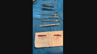 فیلم بلفاروپلاستی در حین عمل